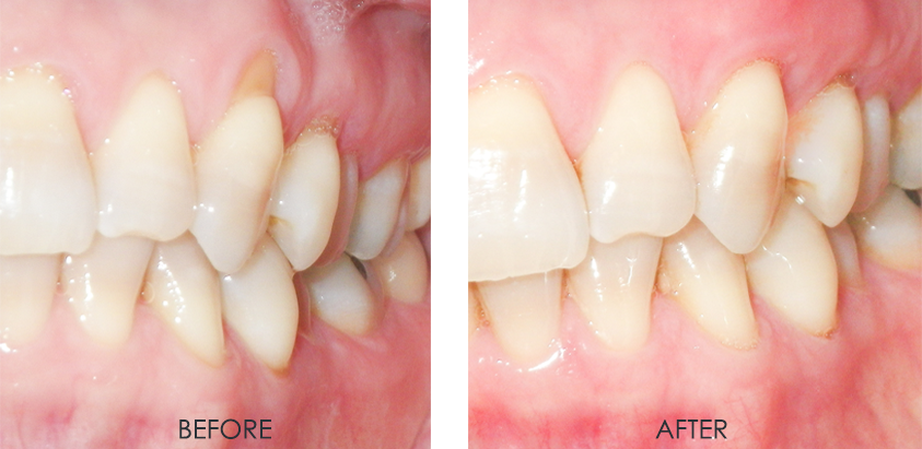 gum recession before and after photo
